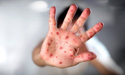 Number of measles patients in Armenia grows to 201