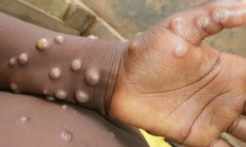 Monkeypox epidemic declared in Congo