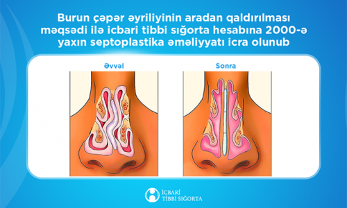 İcbari tibbi sığorta ilə 2000-ə yaxın burun çəpəri əməliyyatı icra olunub