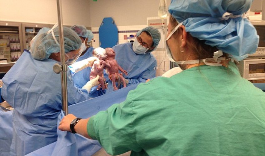 Rare 'mono mono' identical twin girls born HOLDING HANDS - PHOTO Rare 'mono mono' identical twin girls born HOLDING HANDS - PHOTO