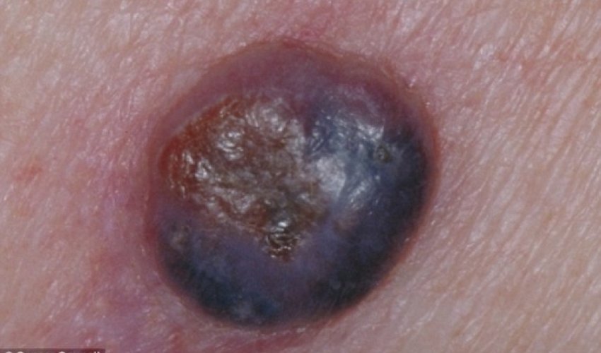 Doctors warn of aggressive form of skin cancer - PHOTO
