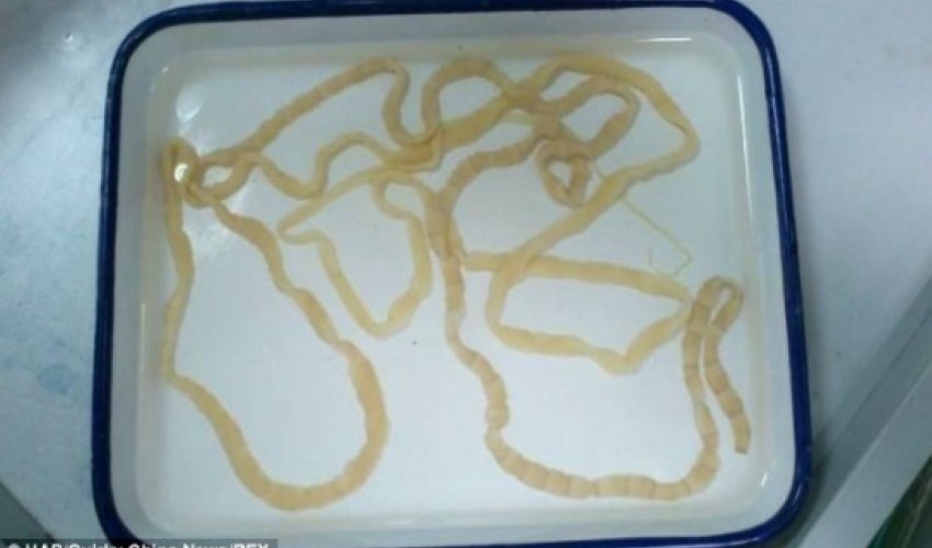 Chinese woman has EIGHT FOOT long tapeworm removed Chinese woman has EIGHT FOOT long tapeworm removed