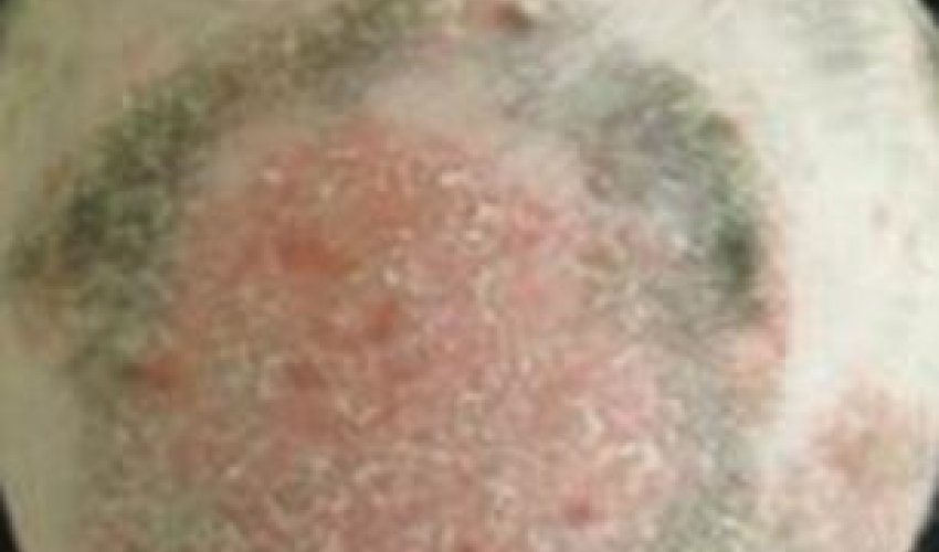 Scientists successfully use arthritis drug to regrow completely bald man's hair - PHOTO Scientists successfully use arthritis drug to regrow completely bald man's hair - PHOTO