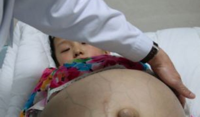 Girl has a watermelon-sized tumour removed from her ovaries - PHOTO