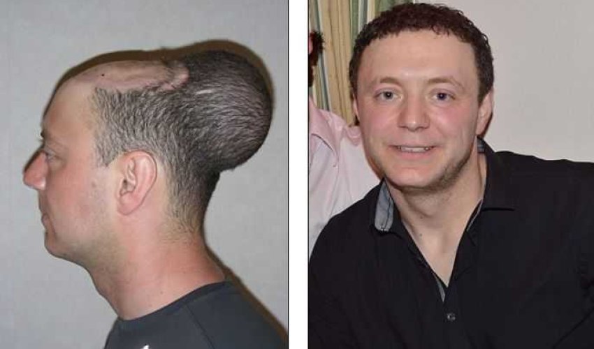 Хирург вставил в голову пациента воздушный шарик- ФОТО Хирург вставил в голову пациента воздушный шарик- ФОТО
