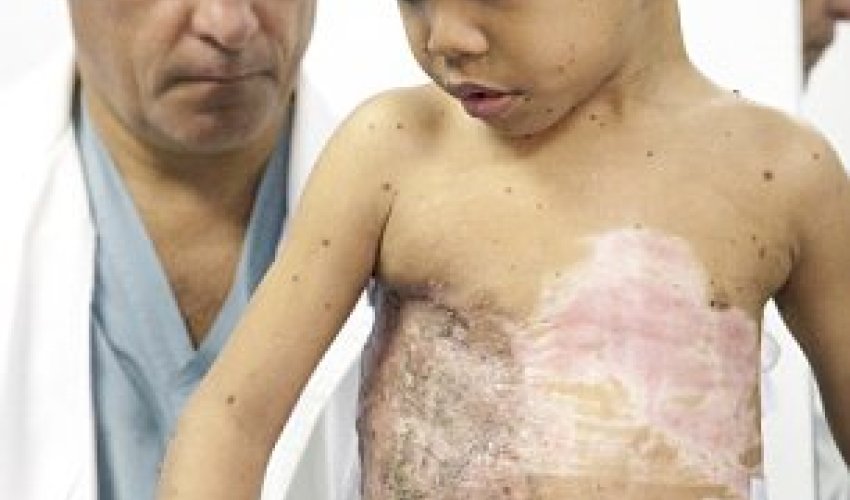 Boy had giant 'turtle shell' mutation removed from his back - PHOTO Boy had giant 'turtle shell' mutation removed from his back - PHOTO