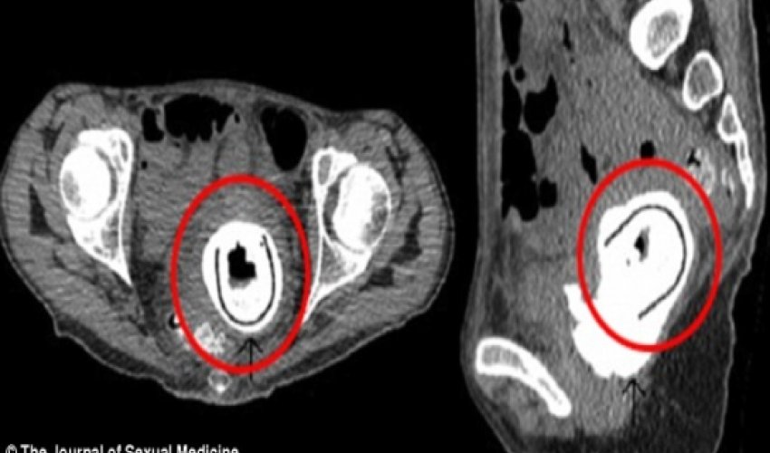 Woman had toy inside her for 10 YEARS Woman had toy inside her for 10 YEARS