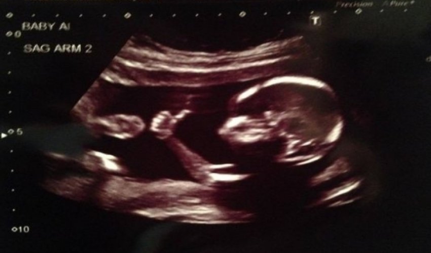 Baby gives thumbs-up in ultrasound photo Baby gives thumbs-up in ultrasound photo