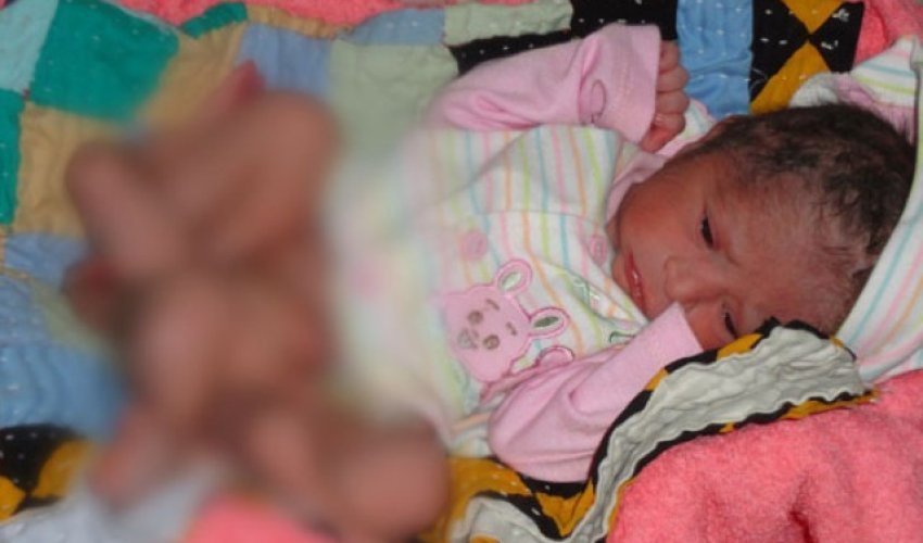 Born with extra limbs - PHOTO Born with extra limbs - PHOTO