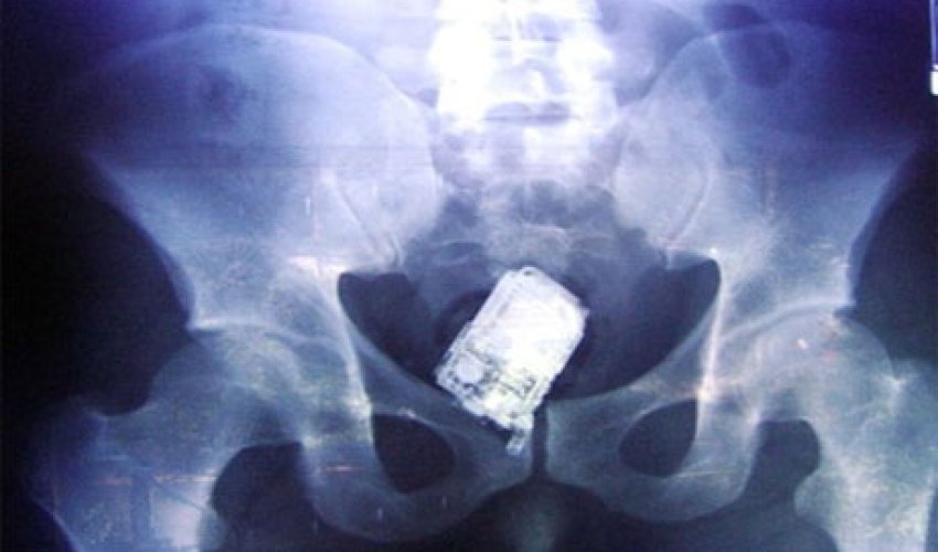 Mədəsindən əl bombası çıxdı - ŞOK FOTOLAR