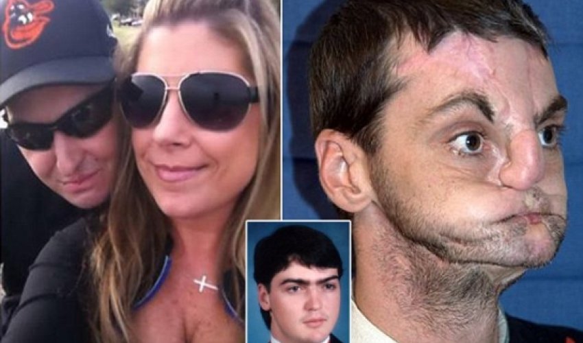 Shotgun victim reveals he’s having to learn how to kiss again - VIDEO Shotgun victim reveals he’s having to learn how to kiss again - VIDEO