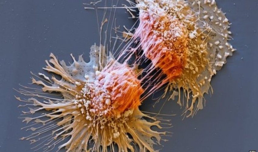 Cancer gene test 'would save lives' Cancer gene test 'would save lives'