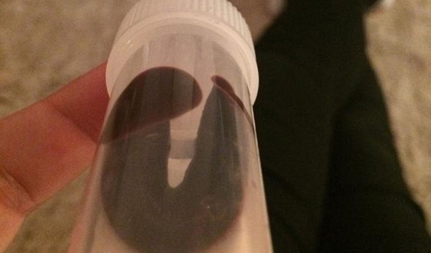 I had a three-inch leech up my nose for a MONTH - PHOTO+VIDEO I had a three-inch leech up my nose for a MONTH - PHOTO+VIDEO