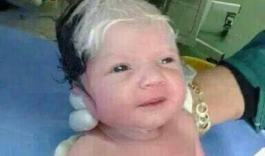 Yeni doğulan körpənin saçı ağardı - ŞOK FOTO Yeni doğulan körpənin saçı ağardı - ŞOK FOTO