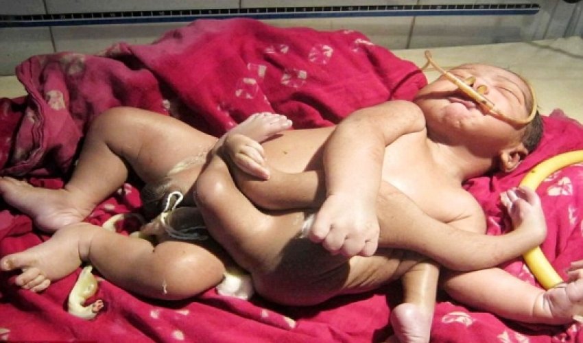 Baby born with four arms and four legs - VIDEO Baby born with four arms and four legs - VIDEO