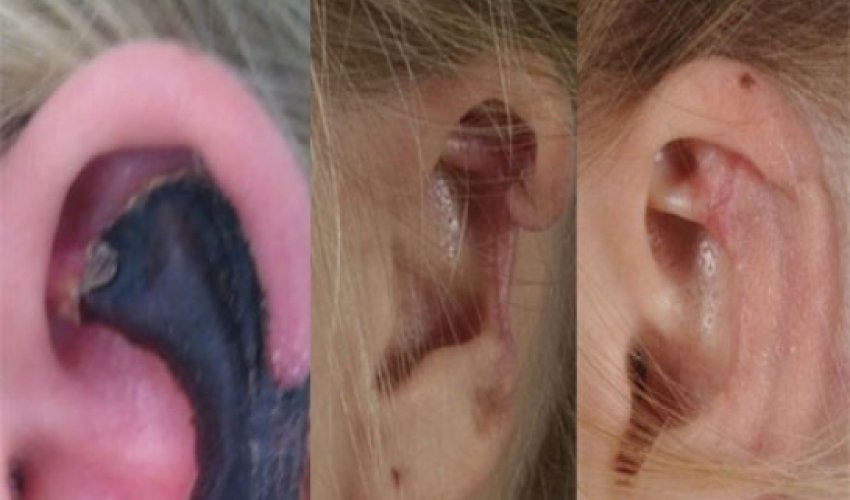 Woman's ear turns black spider bite Woman's ear turns black spider bite
