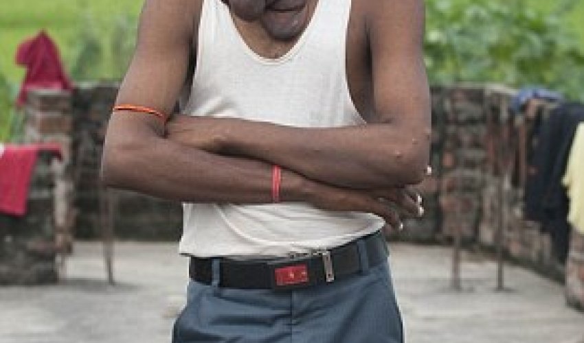 Indian man with huge facial tumour undergoes surgery - PHOTO+VIDEO Indian man with huge facial tumour undergoes surgery - PHOTO+VIDEO