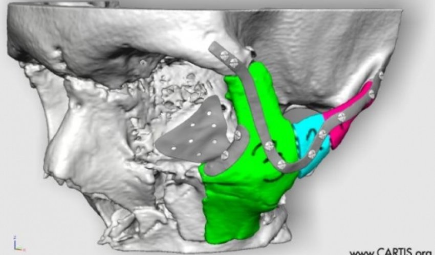 Surgeons will reconstruct road accident victim's face using 3D printing