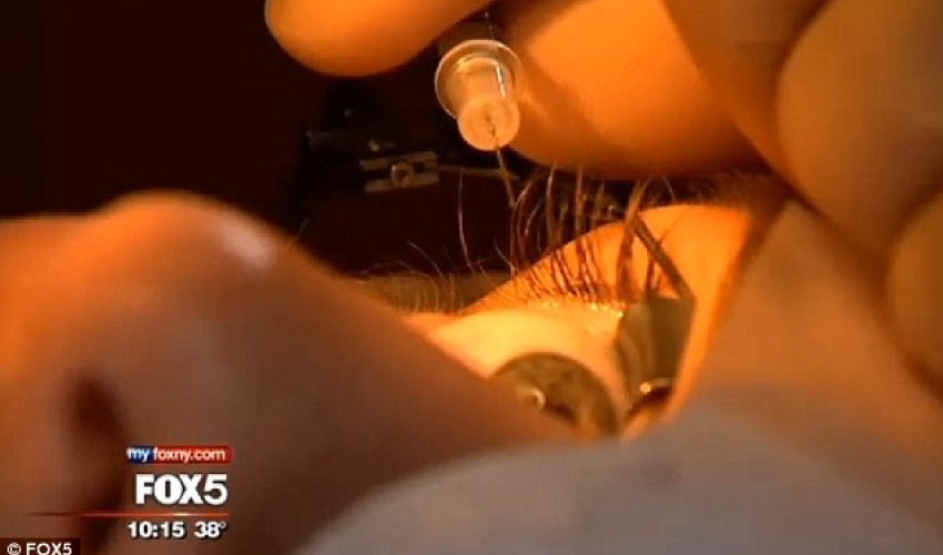 Woman gets platinum jewelry implanted in her optic membrane - PHOTO