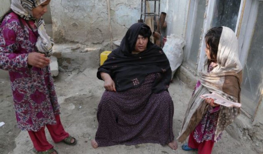 Victim of acid attack shows her terrible scars - PHOTO