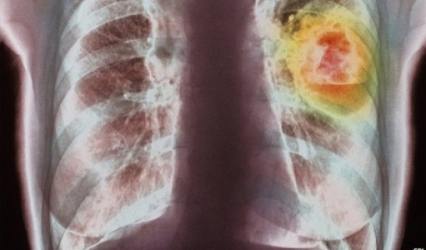 Global cancer cases reach 14 million, WHO says Global cancer cases reach 14 million, WHO says