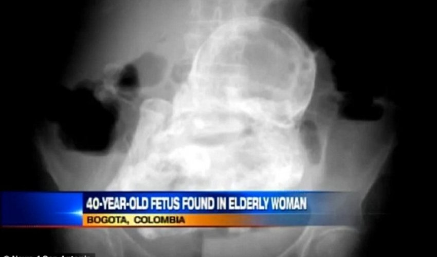 Woman with stomach pain is found to have a 40-year-old fetus inside her Woman with stomach pain is found to have a 40-year-old fetus inside her