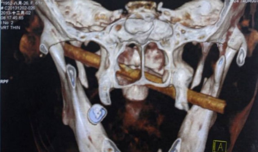 Woman has five-inch bamboo stick lodged in her face - PHOTO Woman has five-inch bamboo stick lodged in her face - PHOTO