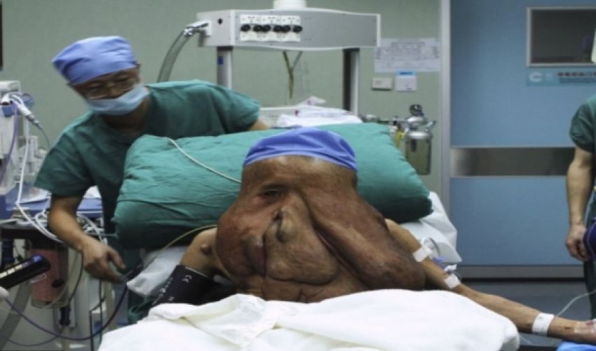 China's 'tumour man' undergoes more surgery - PHOTO China's 'tumour man' undergoes more surgery - PHOTO