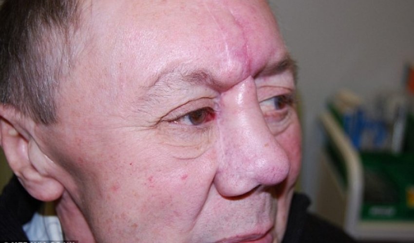 Man has new nose created using bone - PHOTO Man has new nose created using bone - PHOTO