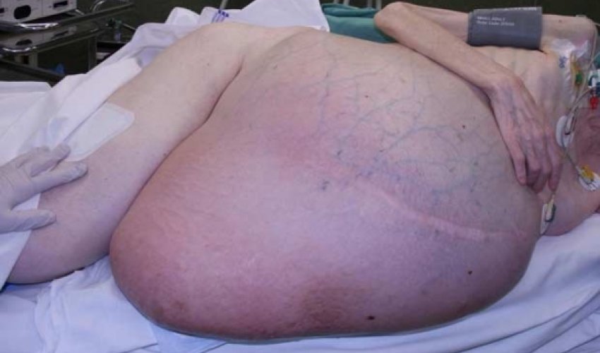 Woman has SIX STONE tumour removed from her stomach - PHOTO Woman has SIX STONE tumour removed from her stomach - PHOTO