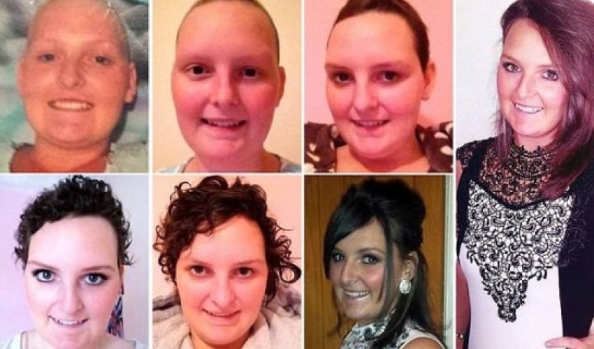 Cancer survivor left bald after treatment charts recovery Cancer survivor left bald after treatment charts recovery