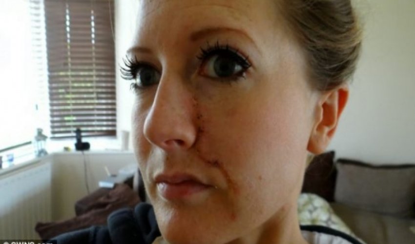 Tanning addict left with massive tumour on her face Tanning addict left with massive tumour on her face