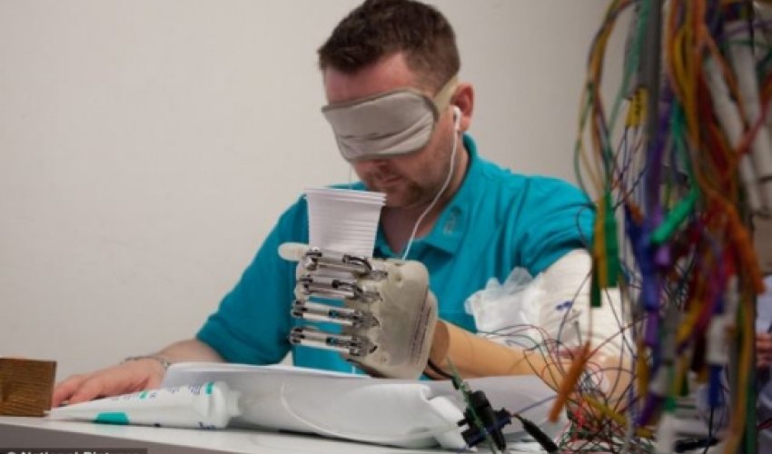 Bionic hand makes patient the first amputee in the world Bionic hand makes patient the first amputee in the world