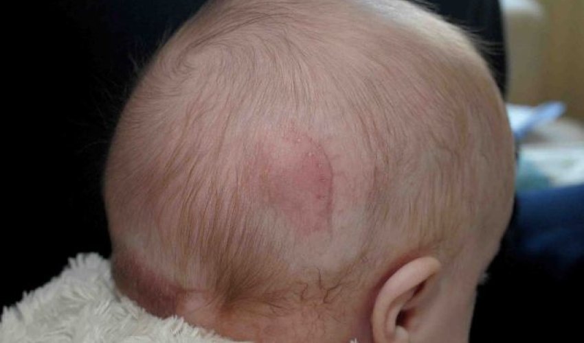 Baby girl born with part of her brain OUTSIDE her skull - PHOTO Baby girl born with part of her brain OUTSIDE her skull - PHOTO