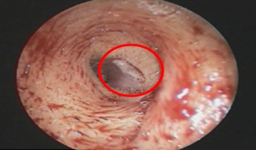 Woman discovers she has a MAGGOT living in her ear