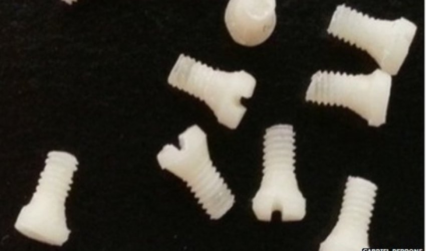 Silk screws used to repair fractures Silk screws used to repair fractures
