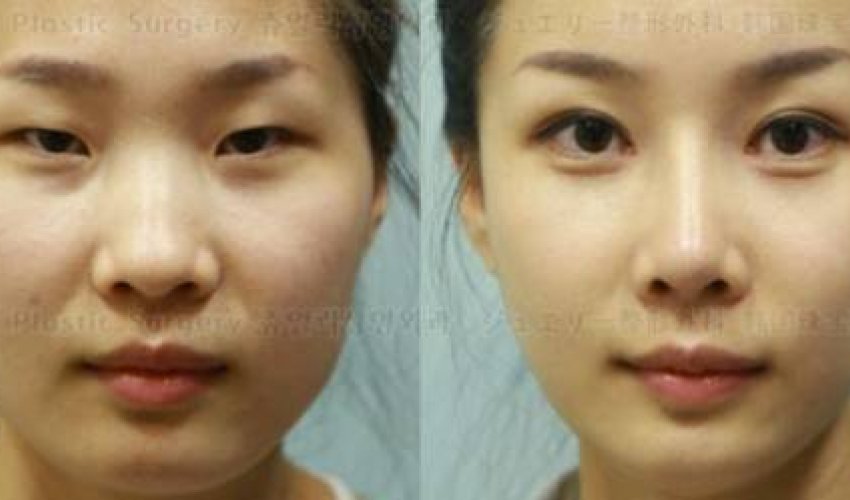 Plastic surgery in South Korea is so good - PHOTO Plastic surgery in South Korea is so good - PHOTO