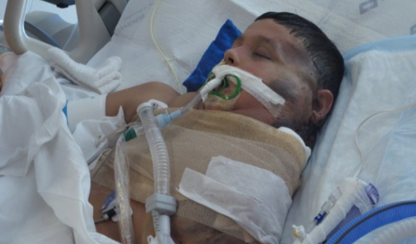 Mexican boy is recovering after watermelon-sized tumor is removed - VIDEO