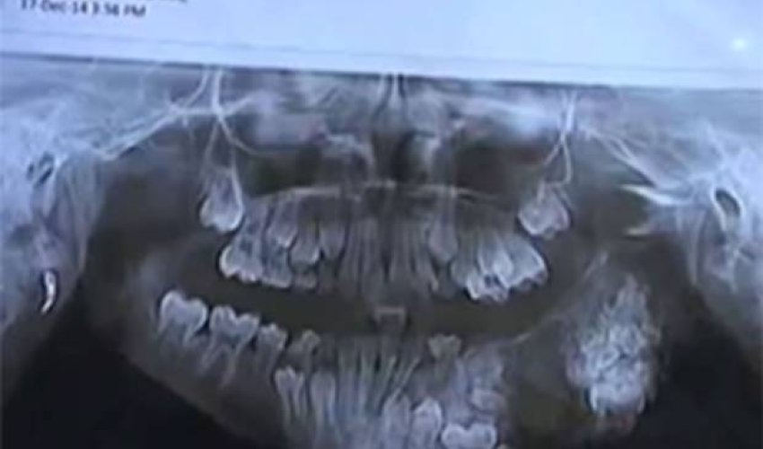 Doctors remove 80 teeth from boy's jaw