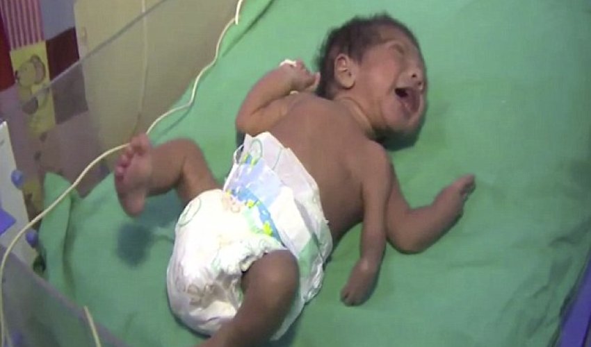 Baby born with THREE arms