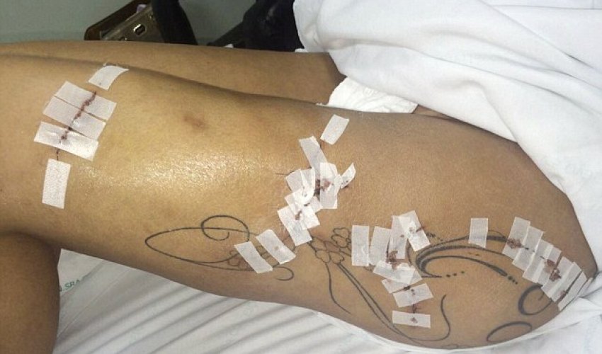 Miss BumBum contestant reveals the shocking damage caused by fillers injected Miss BumBum contestant reveals the shocking damage caused by fillers injected