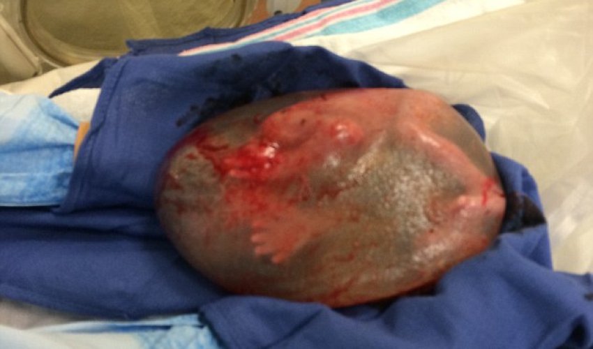 Baby born still INSIDE his amniotic sac