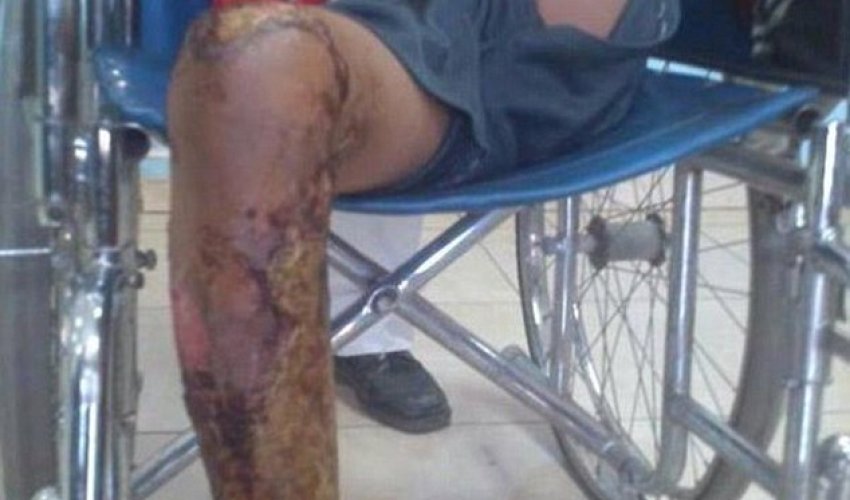 Yemeni boy, 10, locked in a cage and set alight by his friends Yemeni boy, 10, locked in a cage and set alight by his friends