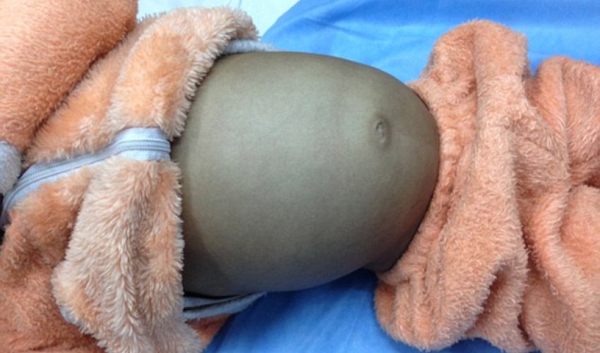 Boy, 4, has huge 4ft hairball removed by doctors