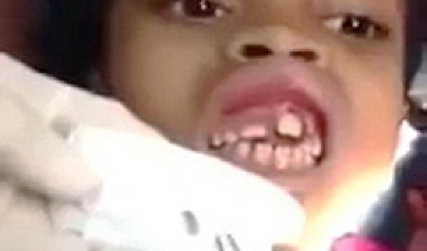 Dentist removing 15 MAGGOTS from inside little girl's gum