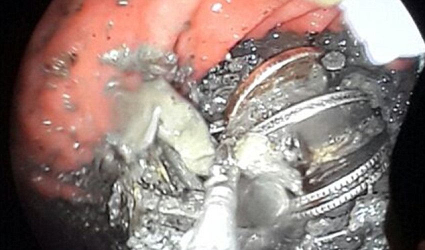 Farmer is found to have hundreds of coins and nails in his STOMACH