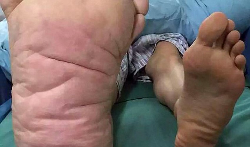 The man whose foot swelled to an astonishing size TWENTY-NINE