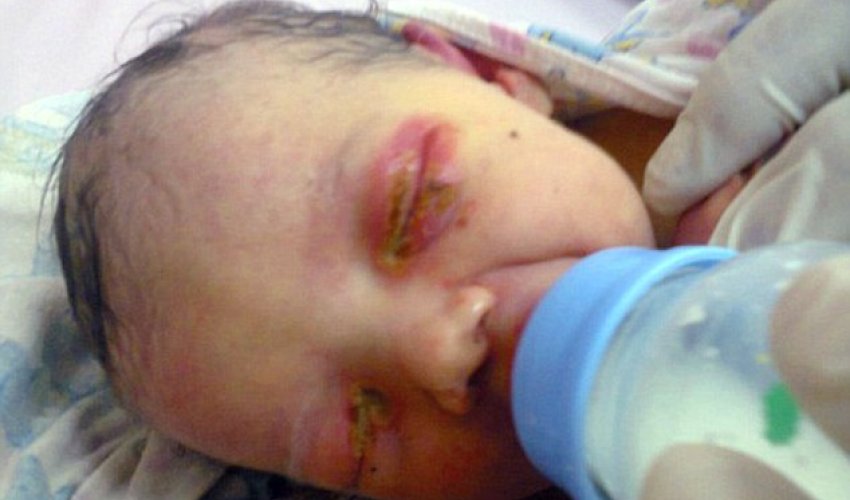 Three-day-old baby girl found covered in ant bites Three-day-old baby girl found covered in ant bites