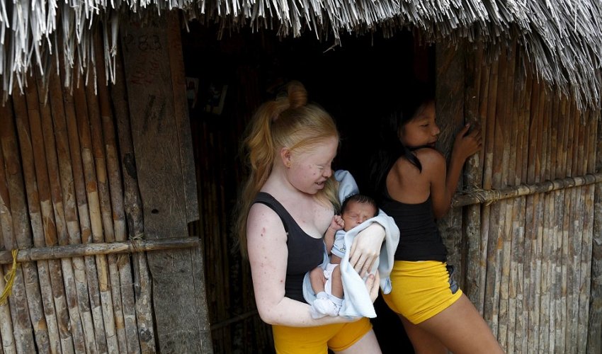 Albino youngsters are forced to stay out of the bright sun in Panama village