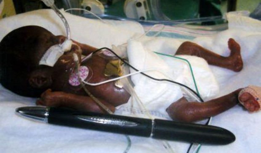 284 qram doğulan qızın son durumu - FOTOLAR